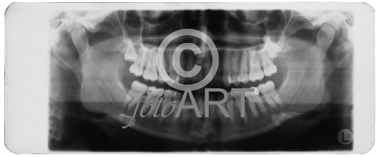 Röntgenaufnahme Zähne